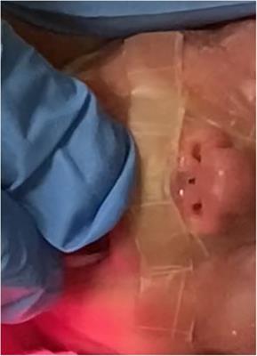 Case Report: Could topical epidermal growth factor be considered a new therapy for skin injuries in premature infants?